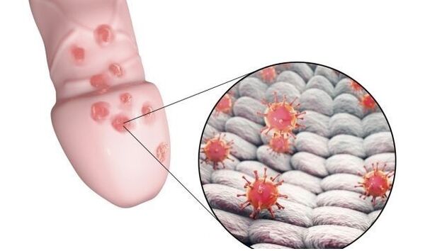 Allergie op Penisvergréisserungsgel