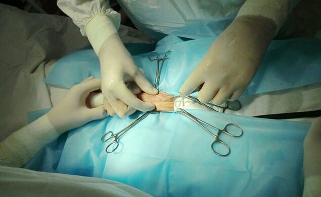 Chirurgie op de reproduktive Organ hëlleft seng Gréisst ze vergréisseren