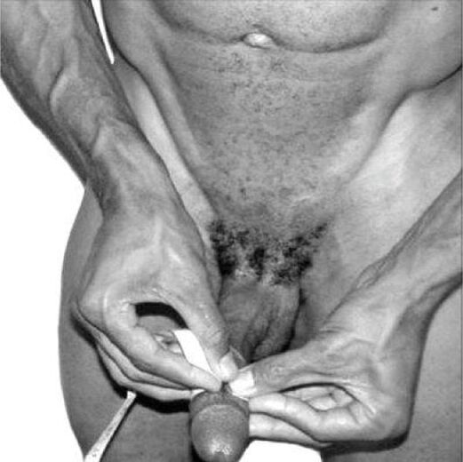 Penismiessung virun der Erweiderung